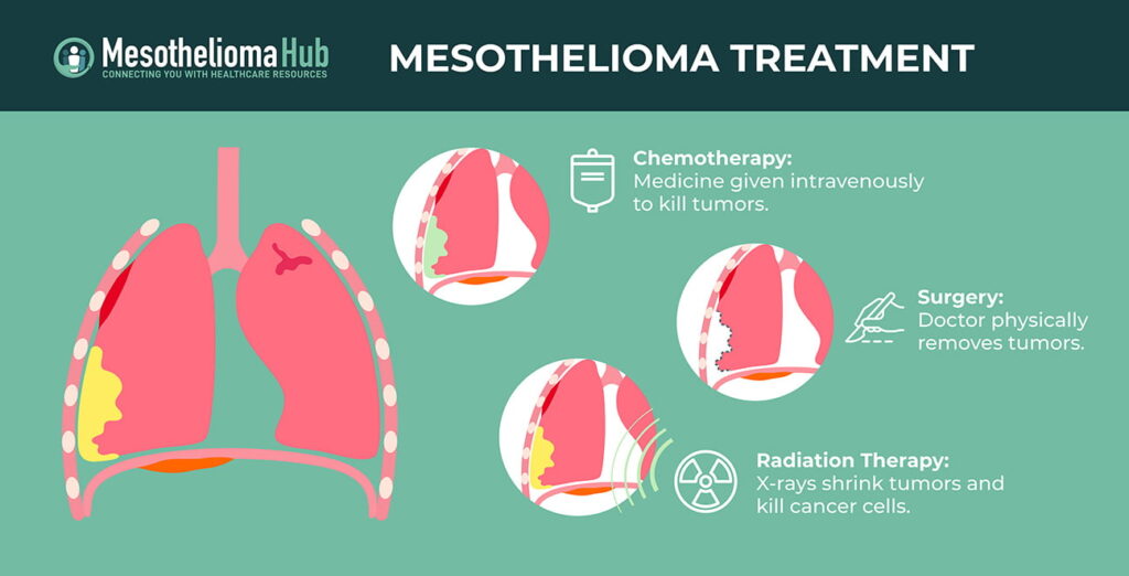 What resources are available for mesothelioma victims in Columbus?