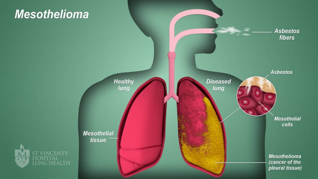 What Is Mesothelioma? – Learn the Facts!